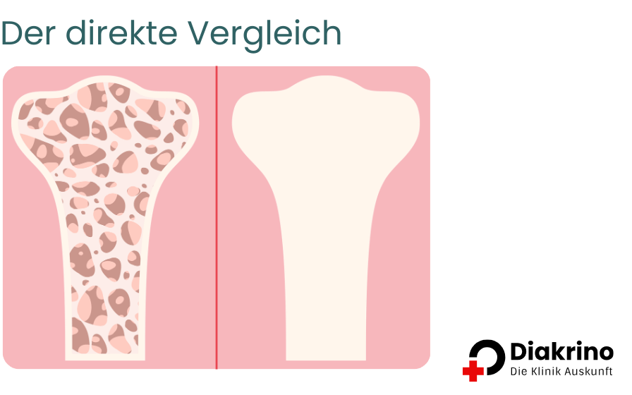 Osteoporose - Ursachen, Symptome und Behandlungsmöglichkeiten(4)