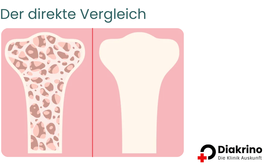 Osteoporose - Ursachen, Symptome und Behandlungsmöglichkeiten(4) Osteoporose - Ursachen, Symptome und Behandlungsmöglichkeiten(4)